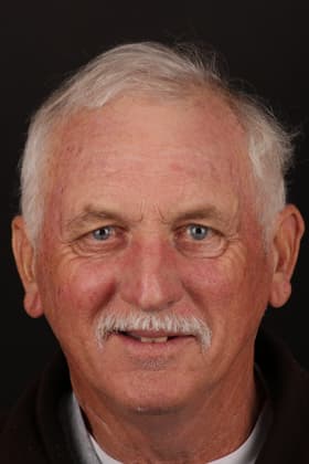 Before and after smile transformation by Advanced Dental Implant and TMJ Center in Southaven, MS.